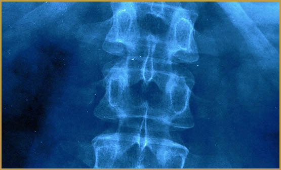 cannabis-and-spinal-cord-injuries