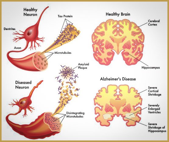 bigstock-alzheimer-55097363