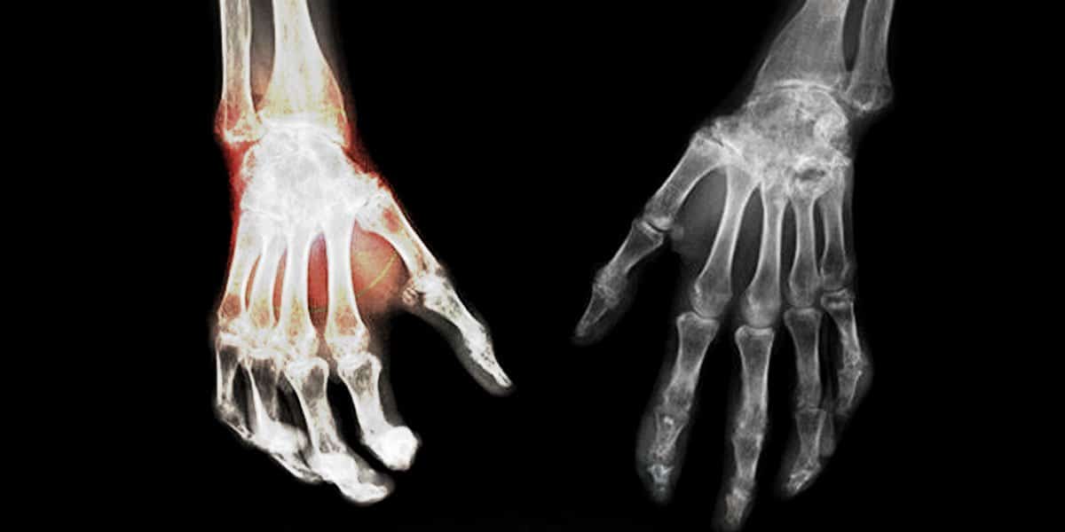 rôle du cb2 dans le syndrome douloureux régional complexe 4