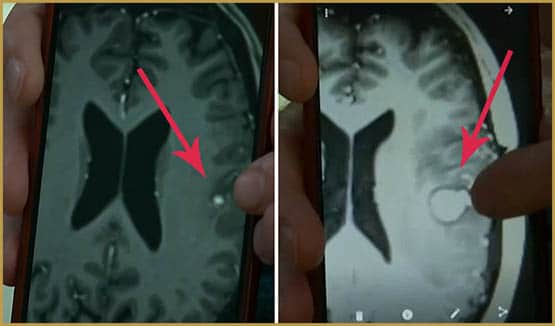 Une nouvelle étude israélienne prouve que le cannabis provoque la mort des cellules cancéreuses