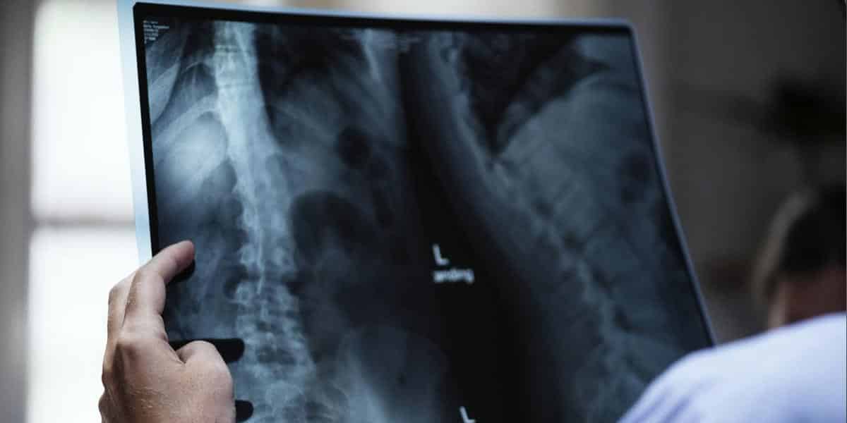 blessures liées à la moelle épinière 3