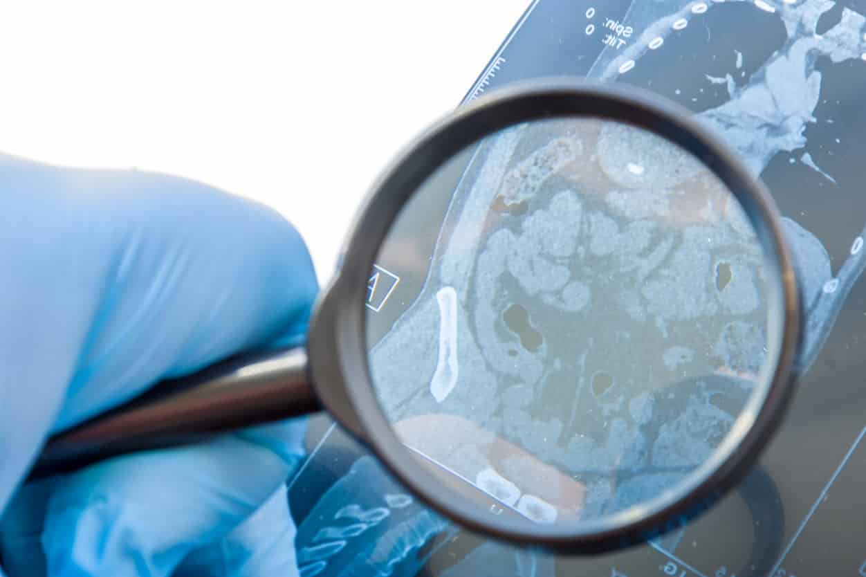 Le stress exacerbe nos intestins