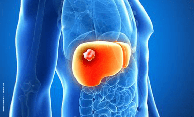 cancer du foie© Sebastian Kaulitzki Fotolia.com  1