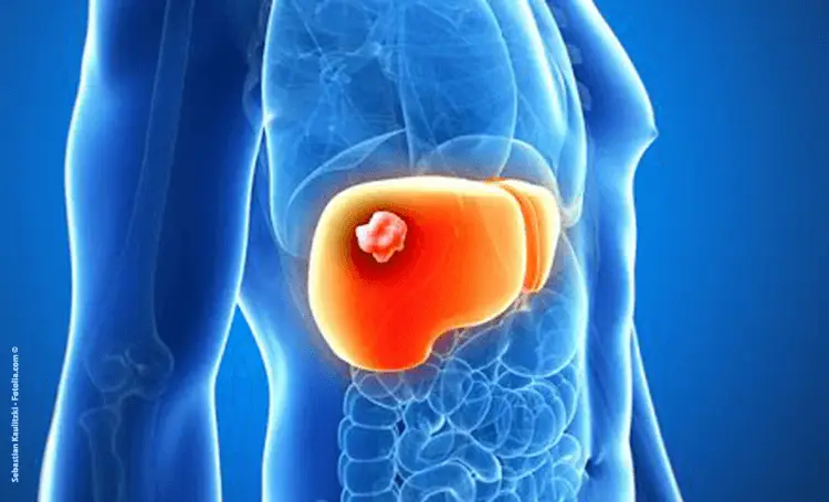 cancer du foie© Sebastian Kaulitzki Fotolia.com 1 cancer du foie© Sebastian Kaulitzki Fotolia.com 1
