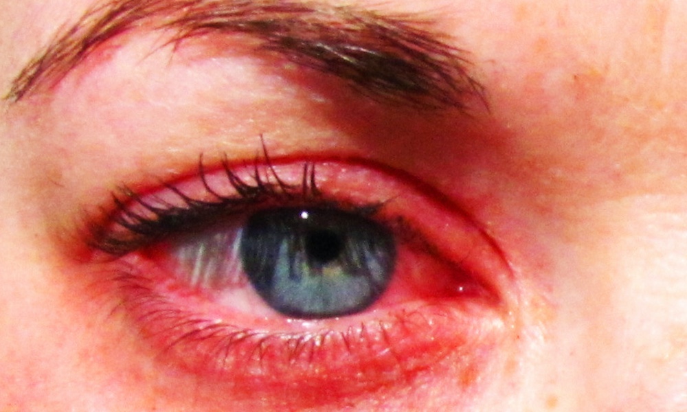red eye